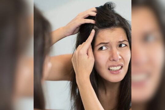 कोंड्यामुळे डोकं खाजवून झालात बेजार तर करून पाहा 'हा' घरगुती उपाय