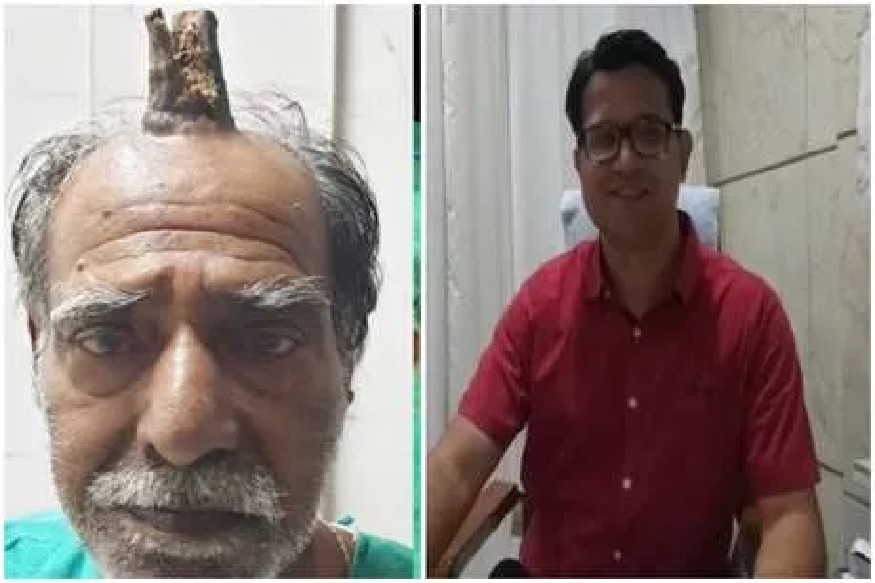 सर्जरीनंतरही पुन्हा-पुन्हा उगवतं या व्यक्तीच्या डोक्यावर शिंग, डॉक्टरही वैतागले