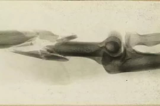 फ्रॅक्चर झालंय? या प्रोटीनपासून रहा सावधान, होऊ शकतं नुकसान!