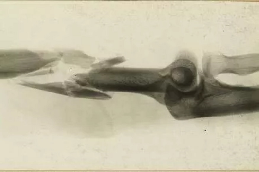 फ्रॅक्चर झालंय? या प्रोटीनपासून रहा सावधान, होऊ शकतं नुकसान!