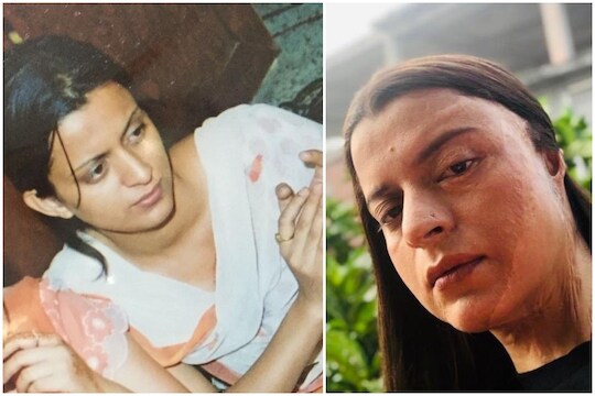 कंगनाच्या बहिणीवर झाला होता अॅसिड अटॅक; धक्कादायक फोटोतून उलगडली कहाणी