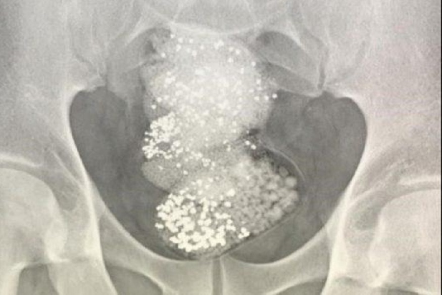 कमालच म्हणायची! चुरा करून खाल्ला 64 लाखांचा हिरा, X-Rayनं शोधला चोर