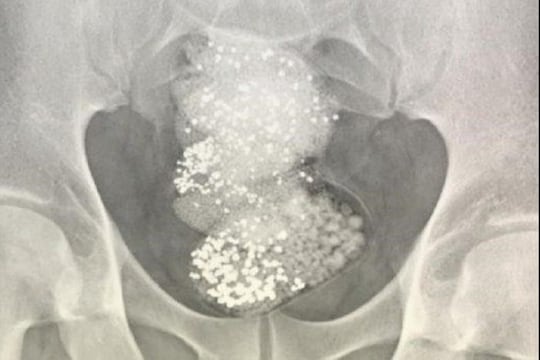 कमालच म्हणायची! चुरा करून खाल्ला 64 लाखांचा हिरा, X-Rayनं शोधला चोर