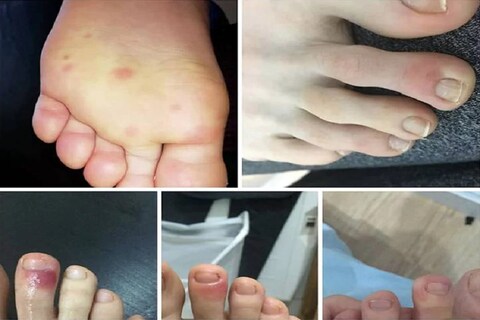 स्पेन, इटली, फ्रान्समधील coronavirus रुग्णांच्या पायावर असे डाग (bruising and lesions on feet) दिसून आलेत.
