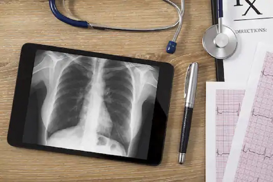 X-ray मार्फत होऊ शकतं कोरोनाव्हायरसचं निदान; खर्च आणि वेळही वाचणार