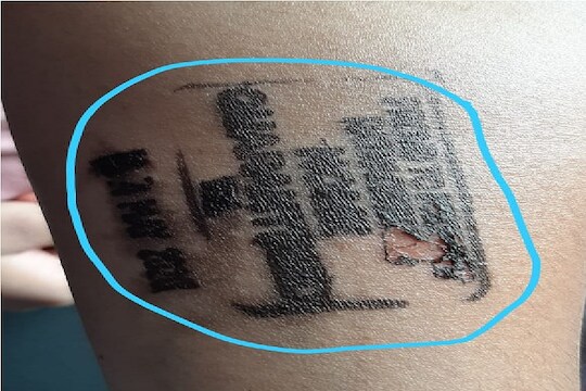 क्वारंटाईन स्टॅम्पचा लहान मुलांच्या त्वचेवर परिणाम, हातावर झाल्या जखमा