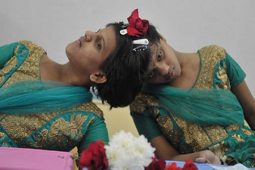 डोकी एकमेकींना चिकटलेल्या अवस्थेत जन्माला आलेल्या या सयामी जुळ्या मुलींनी दहावीची परीक्षा दिली आणि त्या चांगल्या गुणांनी उत्तीर्ण झाल्या आहेत. डोकी एकमेकींना चिकटलेल्या अवस्थेत जन्माला आलेल्या या सयामी जुळ्या मुलींनी दहावीची परीक्षा दिली आणि त्या चांगल्या गुणांनी उत्तीर्ण झाल्या आहेत.