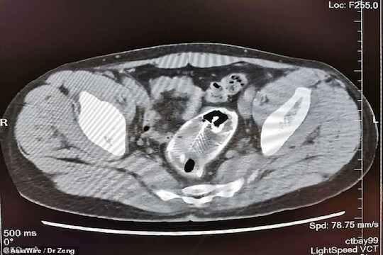 VIDEO : पोटात दुखायला लागलं म्हणून झाला अ‍ॅडमिट, X-ray रिपोर्टमध्ये दिसला जिवंत मासा आणि...