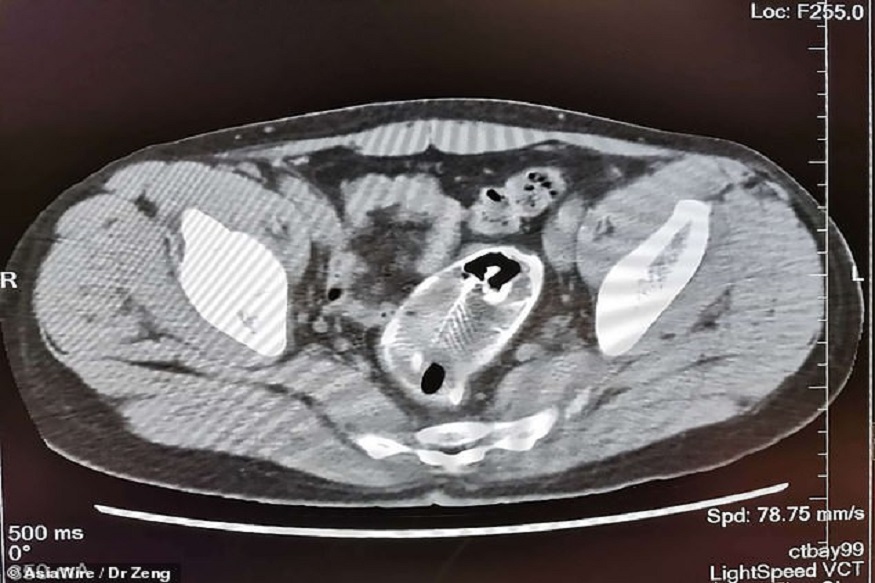 VIDEO : पोटात दुखायला लागलं म्हणून झाला अॅडमिट, X-ray रिपोर्टमध्ये दिसला जिवंत मासा आणि...