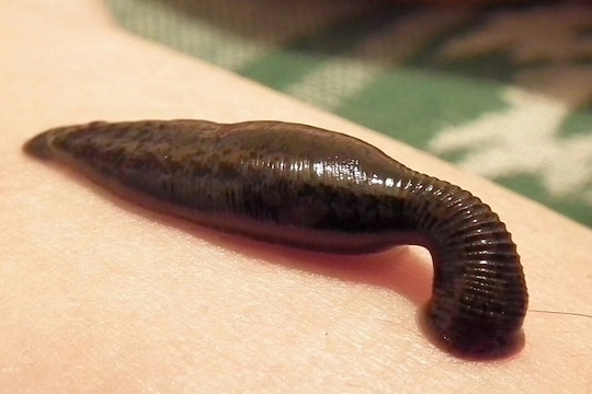 टक्कल आणि त्वचेच्या समस्यांवर प्रभावी अशी जळू उपचार पद्धती