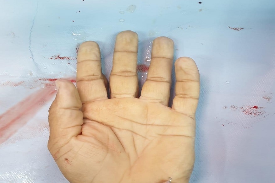 नोएडाच्या सेक्टर 128 मधील जे पी रुग्णायलातील डॉक्टरांनी ही यशस्वी शस्त्रक्रीया केली. यासाठी तब्बल 7 तास डॉक्टरांनी ऑपरेशन केले. नोएडाच्या सेक्टर 128 मधील जे पी रुग्णायलातील डॉक्टरांनी ही यशस्वी शस्त्रक्रीया केली. यासाठी तब्बल 7 तास डॉक्टरांनी ऑपरेशन केले.