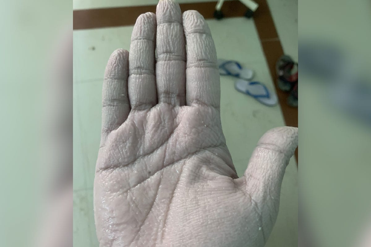 डॉक्टर सय्यद फैजान अहमद यांनी सोशल मीडियावर त्यांच्या हाताचा एक फोटो शेअर केला. यामध्ये त्यांच्या हाताची झालेली अवस्था दिसून येते आहे. त्यांनी असे म्हटले आहे 10 तास सातत्याने पीपीई किट आणि ग्लोव्ह्ज घातल्याने त्यांच्या हाताची अवस्था खराब झाली आहे. (फोटो सौजन्य- ट्विटर) डॉक्टर सय्यद फैजान अहमद यांनी सोशल मीडियावर त्यांच्या हाताचा एक फोटो शेअर केला. यामध्ये त्यांच्या हाताची झालेली अवस्था दिसून येते आहे. त्यांनी असे म्हटले आहे 10 तास सातत्याने पीपीई किट आणि ग्लोव्ह्ज घातल्याने त्यांच्या हाताची अवस्था खराब झाली आहे. (फोटो सौजन्य- ट्विटर)
