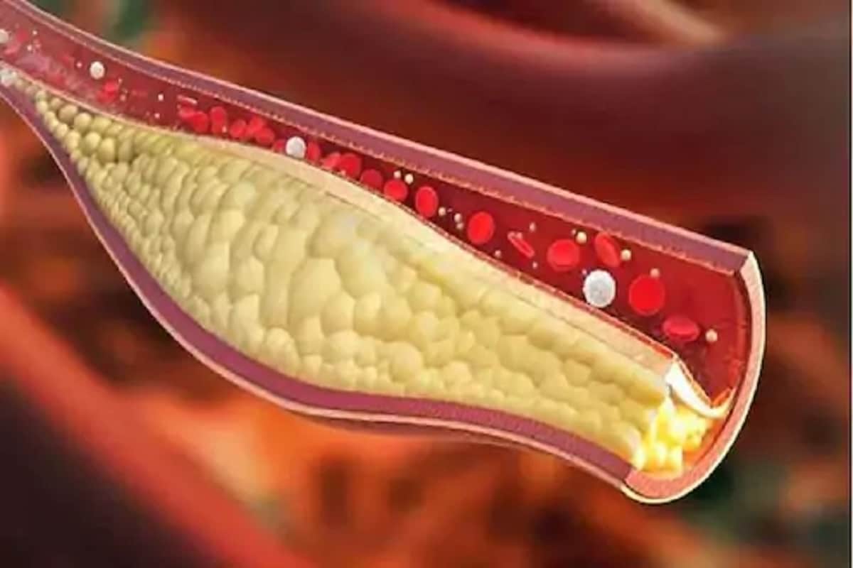 शरीरातील कोलेस्ट्रॉलची (cholesterol) पातळीही सातत्याने तपासत राहावी, कारण याची लक्षणं दिसत नाही आणि अचानक तुम्हाला हार्ट अटॅक किंवा स्ट्रोक येऊ शकतो. त्यामुळे ब्लड टेस्ट करून कोलेस्ट्रॉलची पातळी तपासून घ्यावी आणि कोलेस्ट्रॉलची पातळी नियंत्रित करण्यासाठी डॉक्टरांच्या सल्ल्यानुसार आवश्यक ते बदल करावेत. शरीरातील कोलेस्ट्रॉलची (cholesterol) पातळीही सातत्याने तपासत राहावी, कारण याची लक्षणं दिसत नाही आणि अचानक तुम्हाला हार्ट अटॅक किंवा स्ट्रोक येऊ शकतो. त्यामुळे ब्लड टेस्ट करून कोलेस्ट्रॉलची पातळी तपासून घ्यावी आणि कोलेस्ट्रॉलची पातळी नियंत्रित करण्यासाठी डॉक्टरांच्या सल्ल्यानुसार आवश्यक ते बदल करावेत.