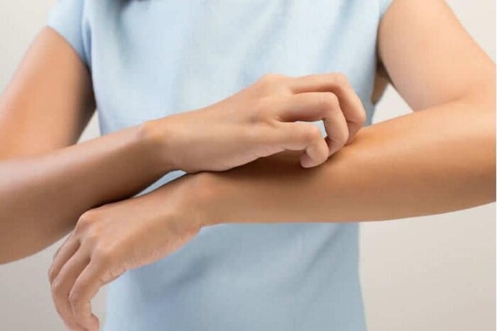 त्वचेला हानी पोहोचणार नाही तसंच जखम होणार नाही याची पुरेपुर काळजी घ्या. सतत खाजवणं टाळा. त्वचारोग तज्ज्ञांच्या सल्ल्याने मलम तसंच औषधांचा वापर करा.