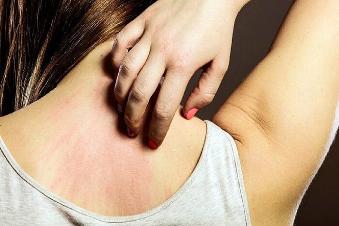 संतुलित आहार आणि व्यायामाला प्राधान्य द्या. औषधं, नॅरो बॅण्ड यूव्हीबी किरणोपचार, सिमर लेजर यामुळे बऱ्याच प्रमाणात सोरासिसला नियंत्रणात ठेवता येतं, असं द एस्थेटिक क्लिनिक्सच्या सल्लागार डर्मेटोलॉजिस्ट डॉ. रिंकी कपूर यांनी सांगितलं.