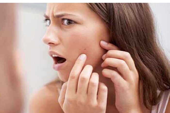 मुरुमांवर उपचार करण्यासाठी तोंडावाटे घेण्यात येणारी प्रतिजैविक औषधं किंवा सौम्य अँटीकॅसिन क्रीम वापरा. बेन्झॉयल पेरोक्साईड किंवा सॅलिसिक अॅसिड असलेली ओटीसी क्रीम खरेदी करू नका, यामुळे त्वचा अधिक कोरडी होईल.