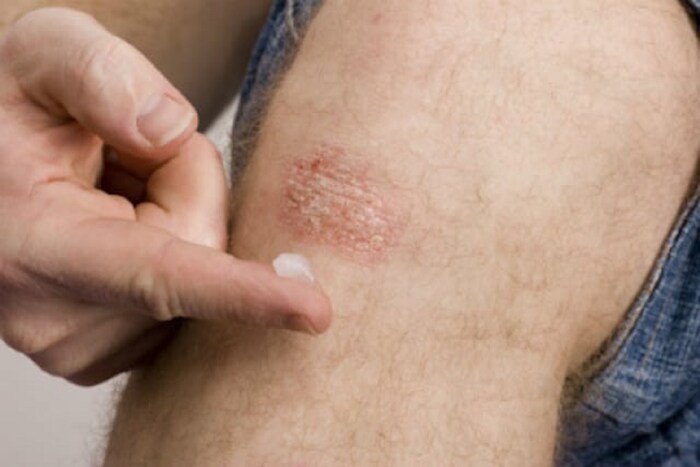 त्वचा कोरडी पडणार नाही याची काळजी घ्या. त्वचेला नियमित मॉईश्चराईज करा. जेव्हा त्वचेमध्ये कोरडेपणा जाणवेल त्यावेळी त्याचा त्वरीत वापर करणं फायदेशीर ठरेल. नारळाच्या तेलामध्ये कोरफडीचा गर मिसळून घरच्या घरी मॉईश्चरायझर बनवू शकता. मध आणि हळद या दोन्ही गोष्टींचा वापर त्वचेवर करू शकता. झोपताना त्वचेवर पेट्रोलिअम जेल तसंच ऑलिव्ह ऑईलचा वापर करू शकता. (Photo - Getty Images)