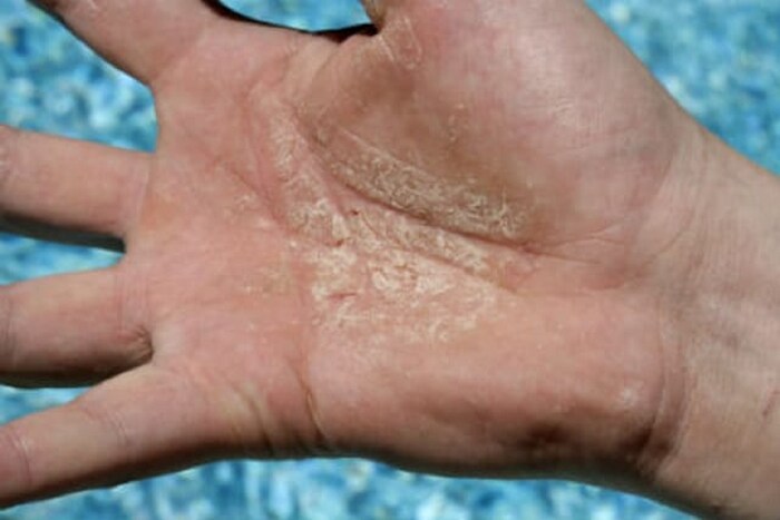 सोरायसिसमध्ये रक्तामधील पांढऱ्या पेशींपैकी टी लिम्फोसाइटमध्ये काही बदल होऊन त्याचा परिणाम त्वचेच्या आतील पेशींवर होतो. यामुळे त्वचेचा एक स्तर निर्माण व्हायला नेहमीपेक्षा कमी वेळ लागतो आणि खवल्यांप्रमाणे जाड त्वचा तयार होऊन लालसर रंगाचे चट्टे त्वचेवर दिसू लागतात. तसंच या चट्ट्यांवर पांढरट पापुद्रेही येतात. (Photo - Getty Images)