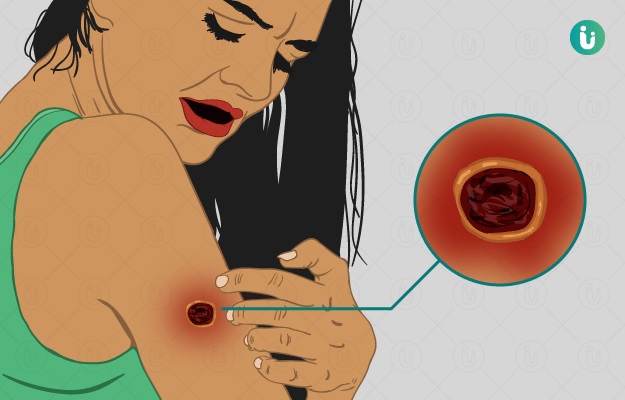 अँथ्रॅक्स हा आजार नेमका काय आहे? कशी घ्यावी काळजी