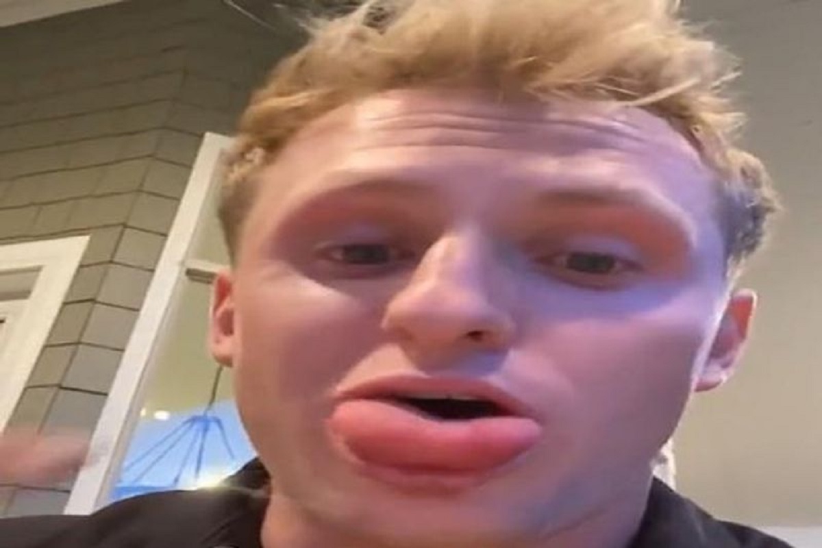 बर्गर खात असाल तर सावधान! या मुलाच्या जीभेची पाहा काय झाली अवस्था, भयंकर VIDEO VIRAL