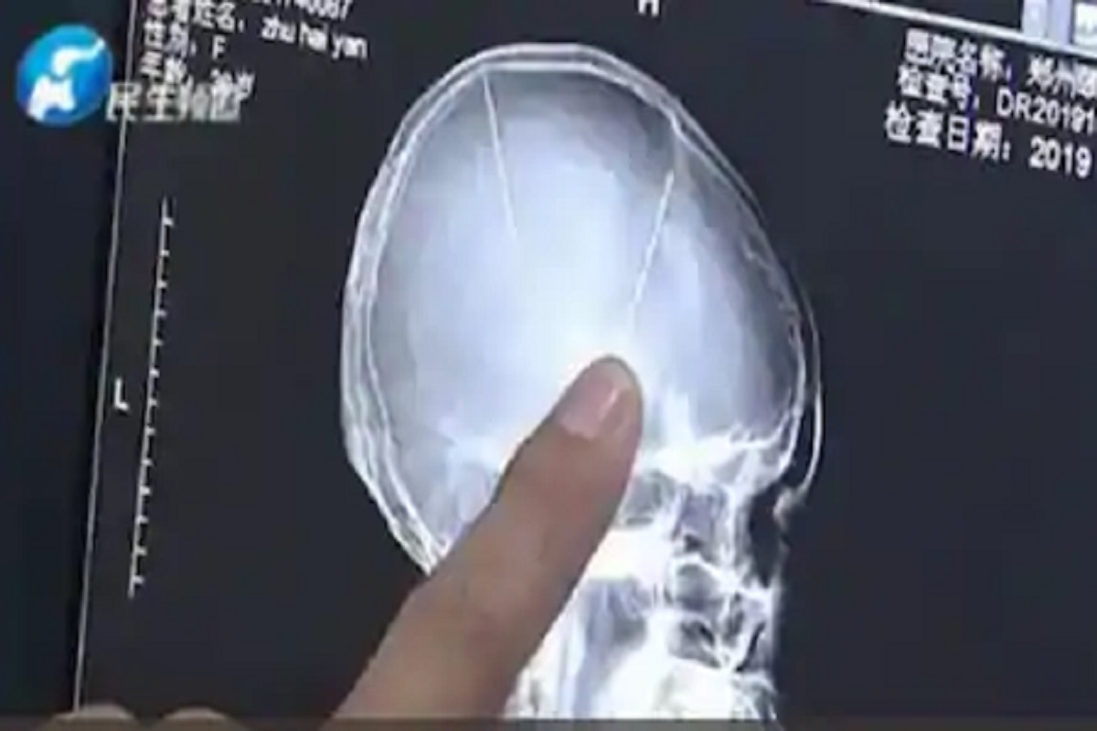 कसं काय शक्य आहे? डोक्याला एकही जखम नाही आणि तिच्या मेंदूत दिसल्या टोकदार वस्तू