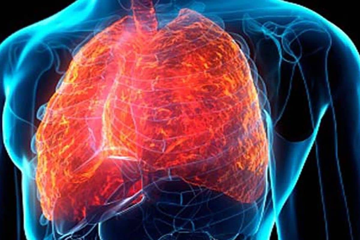 कोरोना व्हायरसमुळे उद्भवणाऱ्या या आजाराचं नाव लंग फायब्रोसिस (Lung Fibrosis) असं आहे. याला पल्मोनरी फायब्रोसिस (Pulmonary Fibrosis)देखील म्हटले जाते. यासंदर्भातील एक लेख इंडिया नावाच्या एका मेडिकल जर्नलमध्ये प्रसिद्ध झाला आहे. हा लेख डॉ. जरीर एफ. उदवादिया, डॉ. परवैज ए. कौल आणि डॉ. लूका रिडेल्डी यांनी लिहिला आहे. तिनही डॉक्टरांनी याला पोस्ट कोविड-19 इंटरस्टिशियल लंग डिजीस (PC-ILD) असल्याचे सांगितले आहे. (फोटोः गेटी) कोरोना व्हायरसमुळे उद्भवणाऱ्या या आजाराचं नाव लंग फायब्रोसिस (Lung Fibrosis) असं आहे. याला पल्मोनरी फायब्रोसिस (Pulmonary Fibrosis)देखील म्हटले जाते. यासंदर्भातील एक लेख इंडिया नावाच्या एका मेडिकल जर्नलमध्ये प्रसिद्ध झाला आहे. हा लेख डॉ. जरीर एफ. उदवादिया, डॉ. परवैज ए. कौल आणि डॉ. लूका रिडेल्डी यांनी लिहिला आहे. तिनही डॉक्टरांनी याला पोस्ट कोविड-19 इंटरस्टिशियल लंग डिजीस (PC-ILD) असल्याचे सांगितले आहे. (फोटोः गेटी)