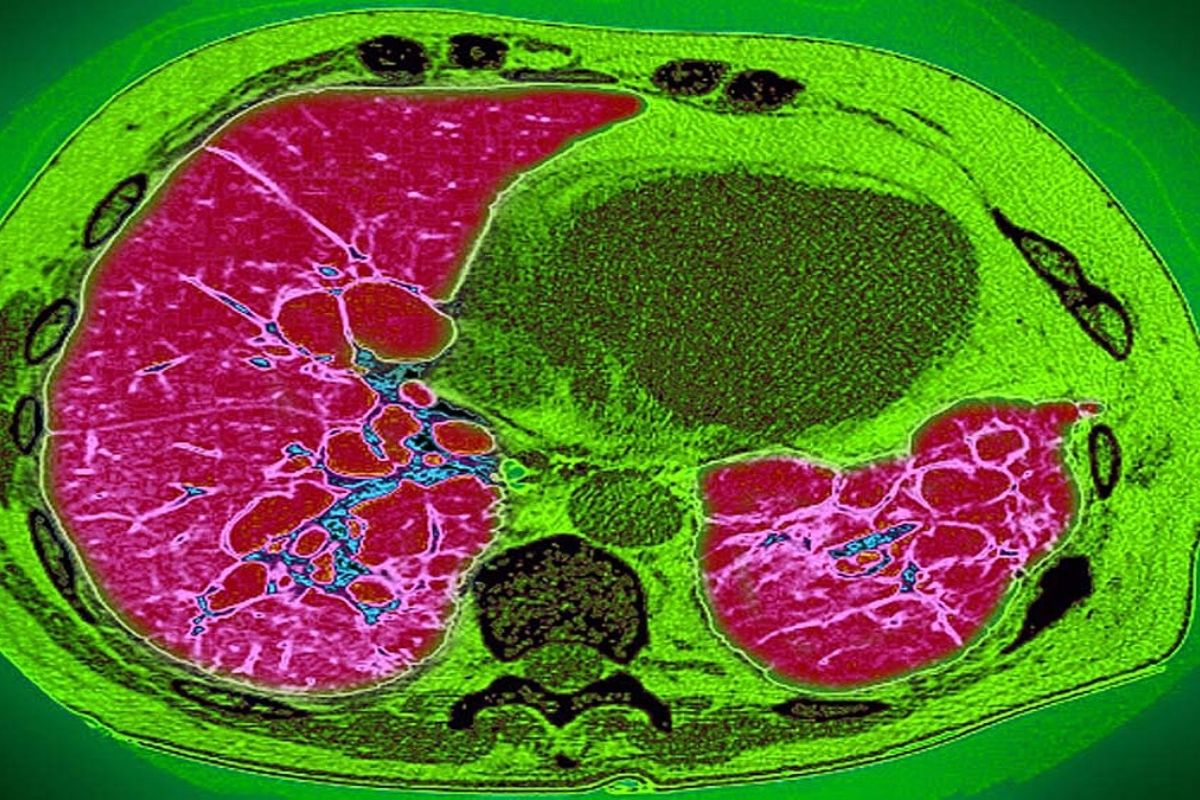 लंग फायब्रोसिस (Lung Fibrosis) आजारात फुप्फुसातील टिश्यूजना (Tissue) सूज येते. याकारणाने फुप्फुसात हवेची जागा कमी होऊ लागते. परिणामी श्वास घ्यायला त्रास होतो. याकारणाने नागरिकांना दम लागतो...थकल्यासारखे वाटत राहते. जर स्थिती अधिक गंभीर झाली तर रुग्णाचा मृत्यूदेखील होऊ शकतो. किंवा त्याला ह्रदयविकाराचा झटका येण्याची शक्यता असते. (फोटोः गेटी) लंग फायब्रोसिस (Lung Fibrosis) आजारात फुप्फुसातील टिश्यूजना (Tissue) सूज येते. याकारणाने फुप्फुसात हवेची जागा कमी होऊ लागते. परिणामी श्वास घ्यायला त्रास होतो. याकारणाने नागरिकांना दम लागतो...थकल्यासारखे वाटत राहते. जर स्थिती अधिक गंभीर झाली तर रुग्णाचा मृत्यूदेखील होऊ शकतो. किंवा त्याला ह्रदयविकाराचा झटका येण्याची शक्यता असते. (फोटोः गेटी)