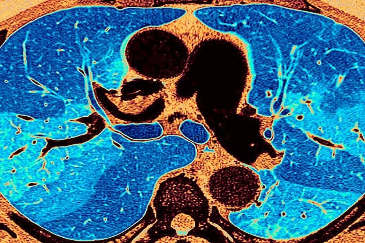 डॉ. उदवादिया यांनी सांगितले की, आम्हाला सातत्याने लंग फायब्रोसिसची (Lung Fibrosis) प्रकरण पाहायला मिळत आहे. जुलै महिन्यात एम्सचे डायरेक्टर डॉ. रणदीप गुलेरिया हे म्हणाले होते की, देशातील डॉक्टरांना रुग्णांची तब्येत ठीक झाल्यानंतरही त्यांच्या शरीरातील इतर अवयवांची चाचणी करायला हवी. कोरोनामुळे त्यांच्या शरीरातील इतर अवयवांवर त्याचा परिणाम झाला की नाही हे पाहायला हवं. (फोटोः गेटी) डॉ. उदवादिया यांनी सांगितले की, आम्हाला सातत्याने लंग फायब्रोसिसची (Lung Fibrosis) प्रकरण पाहायला मिळत आहे. जुलै महिन्यात एम्सचे डायरेक्टर डॉ. रणदीप गुलेरिया हे म्हणाले होते की, देशातील डॉक्टरांना रुग्णांची तब्येत ठीक झाल्यानंतरही त्यांच्या शरीरातील इतर अवयवांची चाचणी करायला हवी. कोरोनामुळे त्यांच्या शरीरातील इतर अवयवांवर त्याचा परिणाम झाला की नाही हे पाहायला हवं. (फोटोः गेटी)