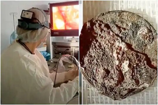 बापरे! तब्बल 50 वर्षे नाकात अडकलेलं नाण डॉक्टरांनी काढलं