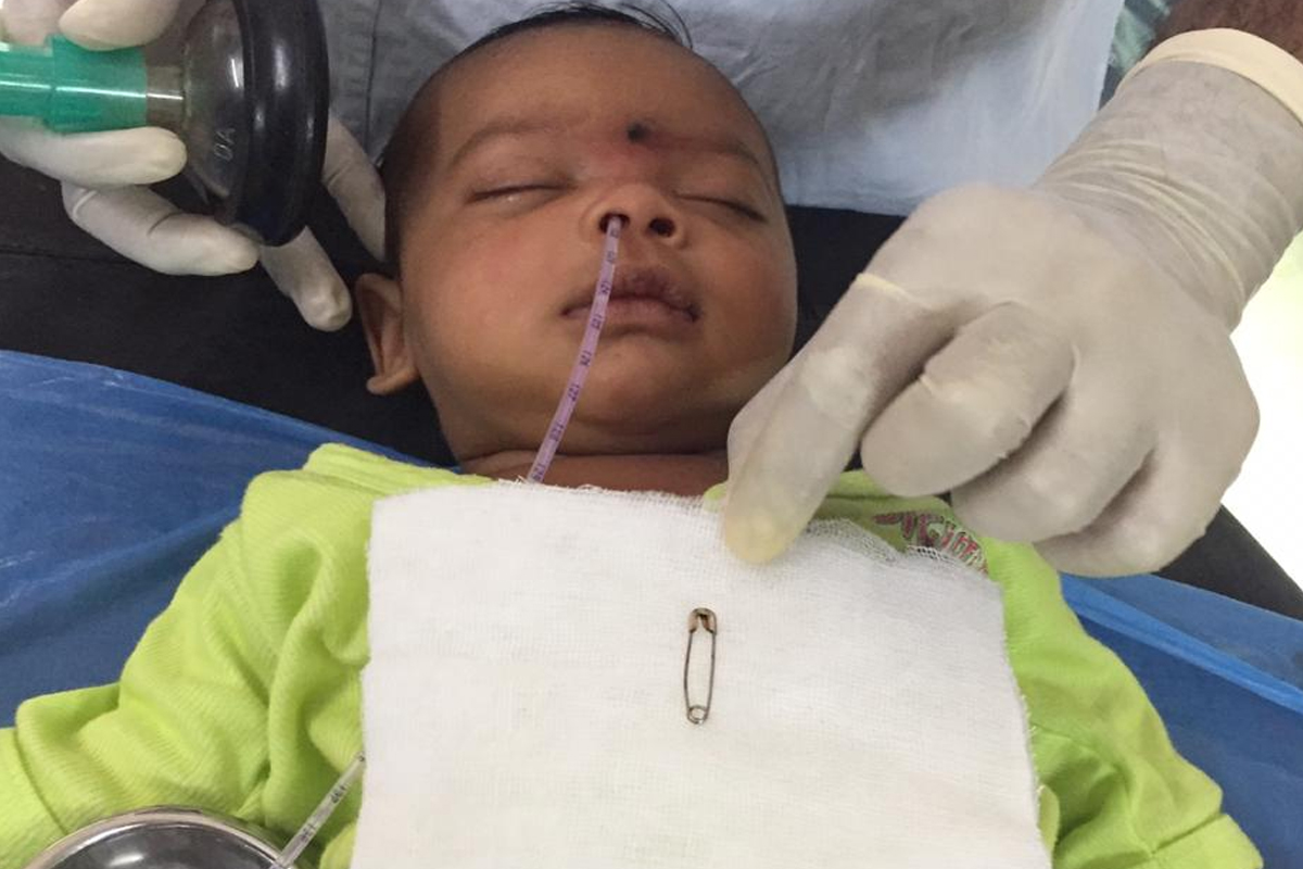 बापरे, दीड महिन्याच्या बाळाच्या श्वसननलिकेत अडकली होती सेफ्टी पिन!