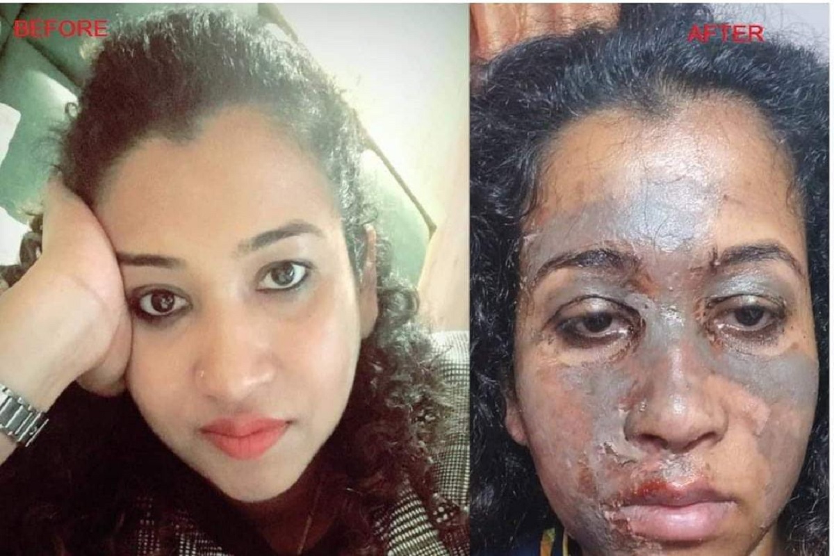 IIT विद्यार्थिनीनंतर आता डॉक्टर महिलेबरोबरही घडला भयानक प्रकार; पार्लर ट्रीटमेंटनंतर चेहऱ्याची झाली ही अवस्था