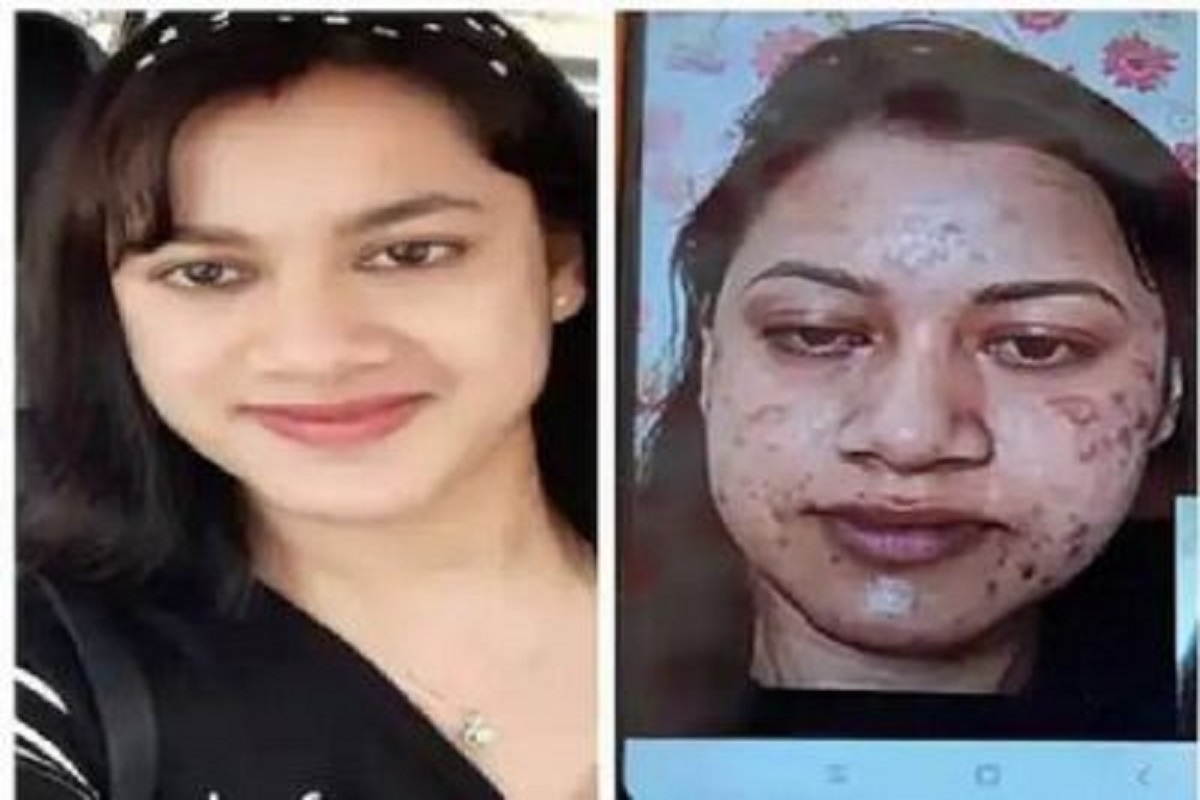 चेहऱ्याची अशी अवस्था नको असेल तर Beauty Treatment घेण्यापूर्वी 'या' गोष्टी लक्षात ठेवा