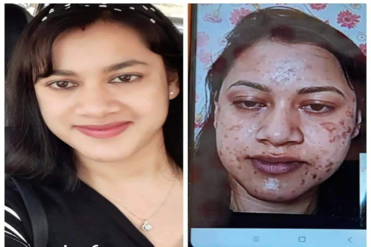 पार्लरमध्ये गेल्यामुळे या महिलांच्या चेहऱ्याची झाली वाईट अवस्था, कुणाचा चेहरा भाजला तर कुणाची त्वचा काळी पडली