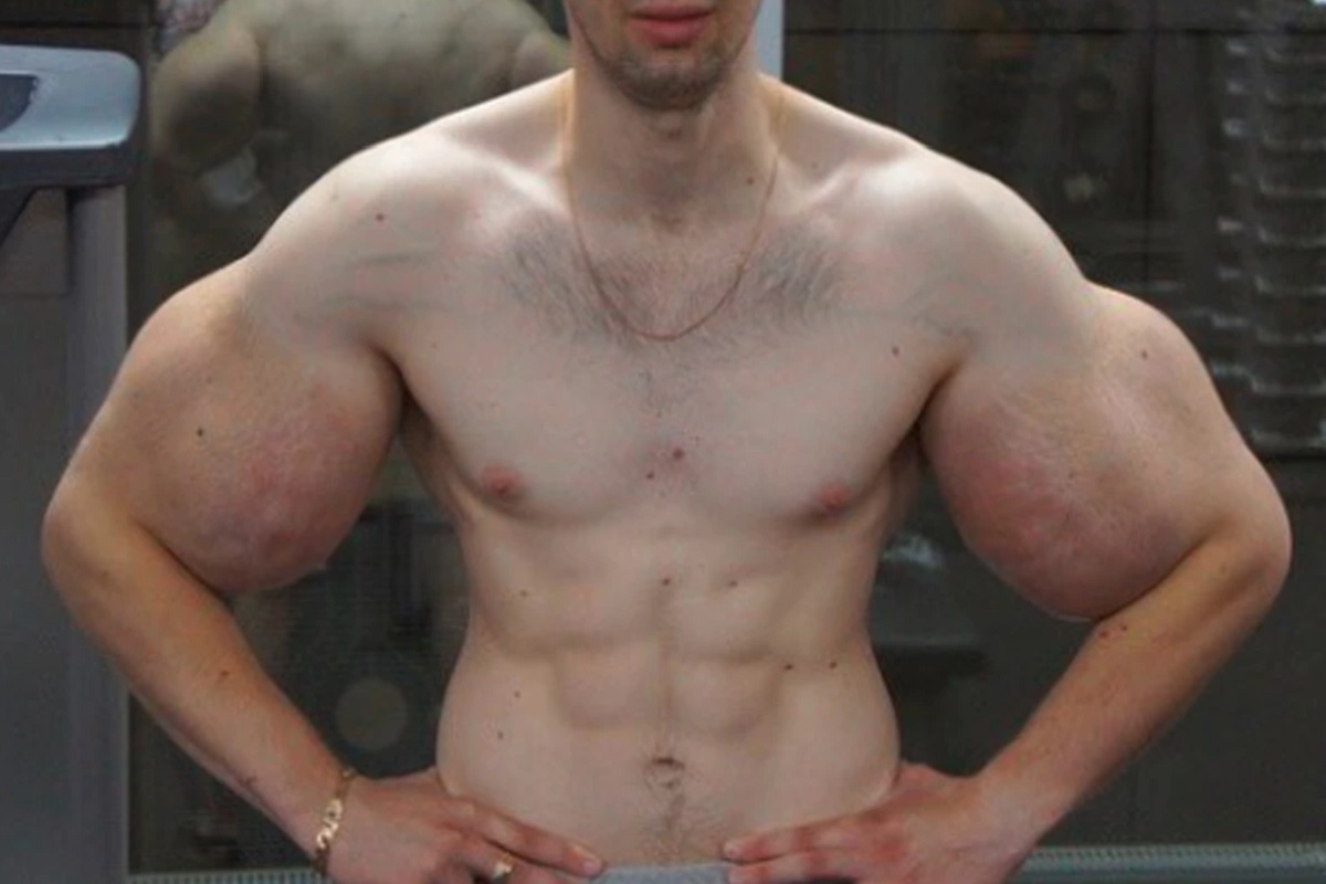 डोले-शोले बनवण्यासाठी केला विचित्र प्रयोग; बॉडीबिल्डरची आता झाली भयंकर अवस्था