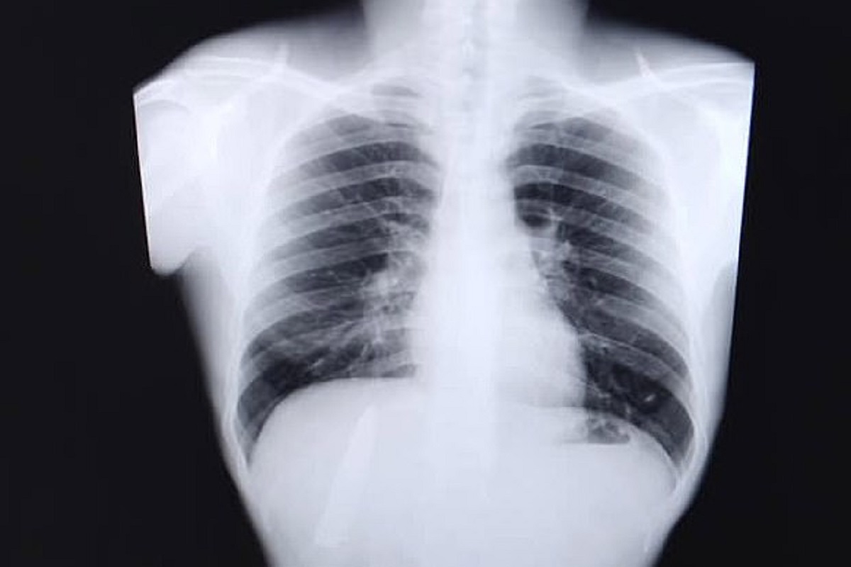 नोकरीची अट म्हणून छातीचा X-Ray काढला आणि रिपोर्ट पाहून तरुण पुरता हादरला