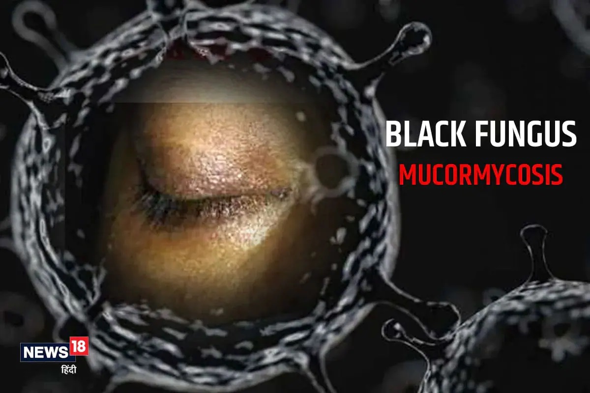 Black Fungusच्या रुग्णांना मोठा दिलासा, भारतात Zydus Cadila आणि TLC उपलब्ध करणार औषध