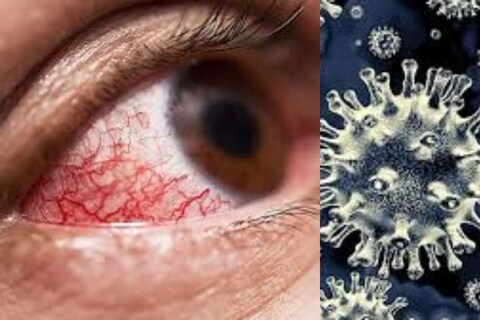 म्युकरमायकोसिस (Mucormycosis) म्हणजेच ब्लॅक फंगसमुळे (Black Fungus) अनेकांनी आपले डोळे (Eyes) गमावले आहेत. अनेकांचा तर यात जीवही गेला आहे.