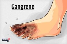 गॅंगरीनमुळे हात-पाय कापण्याची येेऊ शकते वेळ! Diabetes पेशंटला असतो जास्त धोका
