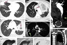 कल्याण-डोंबिवलीत Mucormycosis आजाराचे दोन बळी, सहा रुग्णांवर उपचार सुरू