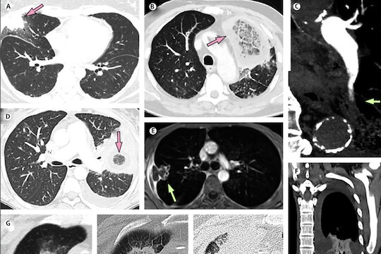 Mucormycosis चे कल्याण-डोंबिवलीत दोन बळी; सहा रुग्णांवर उपचार सुरू