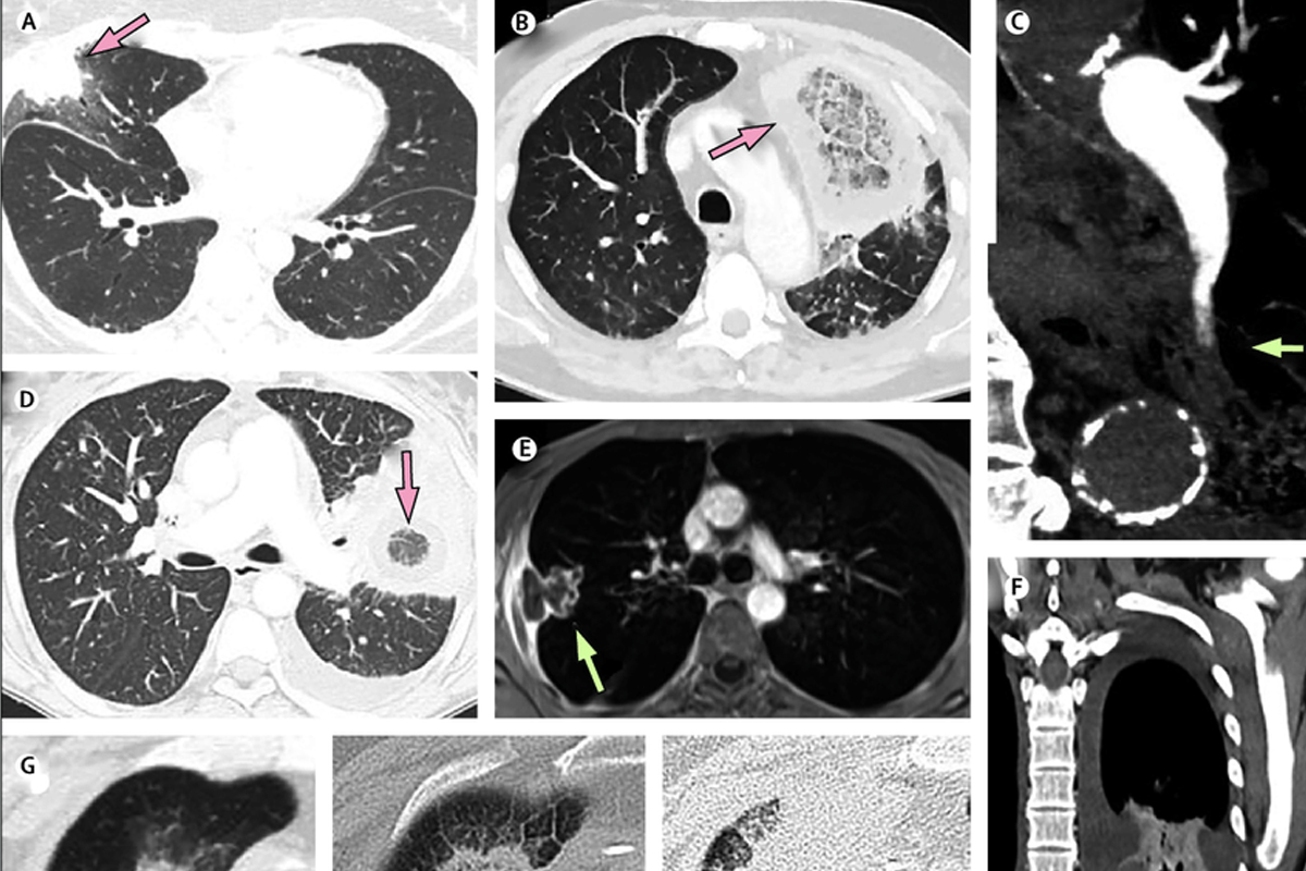 Mucormycosis चे कल्याण-डोंबिवलीत दोन बळी; सहा रुग्णांवर उपचार सुरू