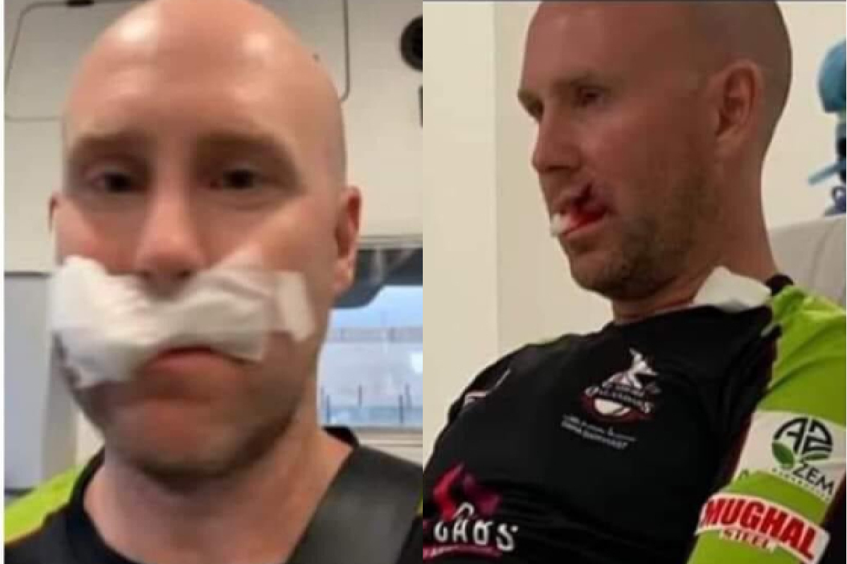 तोंडावर बॉल आपटल्यामुळे क्रिकेटपटू गंभीर जखमी, शस्त्रक्रियेनंतर घातले 7 टाके