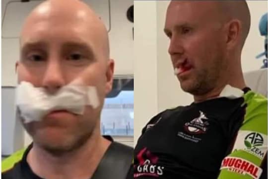 तोंडावर बॉल आपटल्यामुळे क्रिकेटपटू गंभीर जखमी, शस्त्रक्रियेनंतर घातले 7 टाके