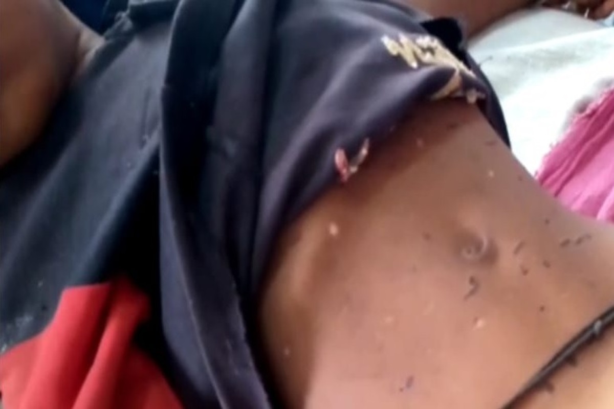 मेळघाटात भोंदूबाबाचे 3 वर्षीय बालकावर अघोरी उपचार, पोटावर चटके दिल्यानं प्रकृती गंभीर