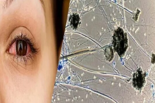 धक्कादायक! 48 तासांत काळे पडले, 42 दिवसांत Black fungus मुळे चिमुकल्यांनी गमावले डोळे