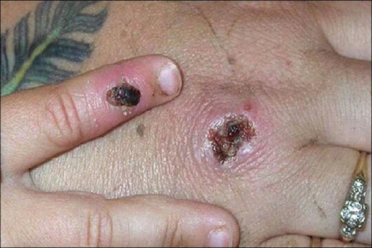 अरे देवा! कोरोनानंतर आता Monkeypox; किती खतरनाक आहे हा व्हायरस पाहा
