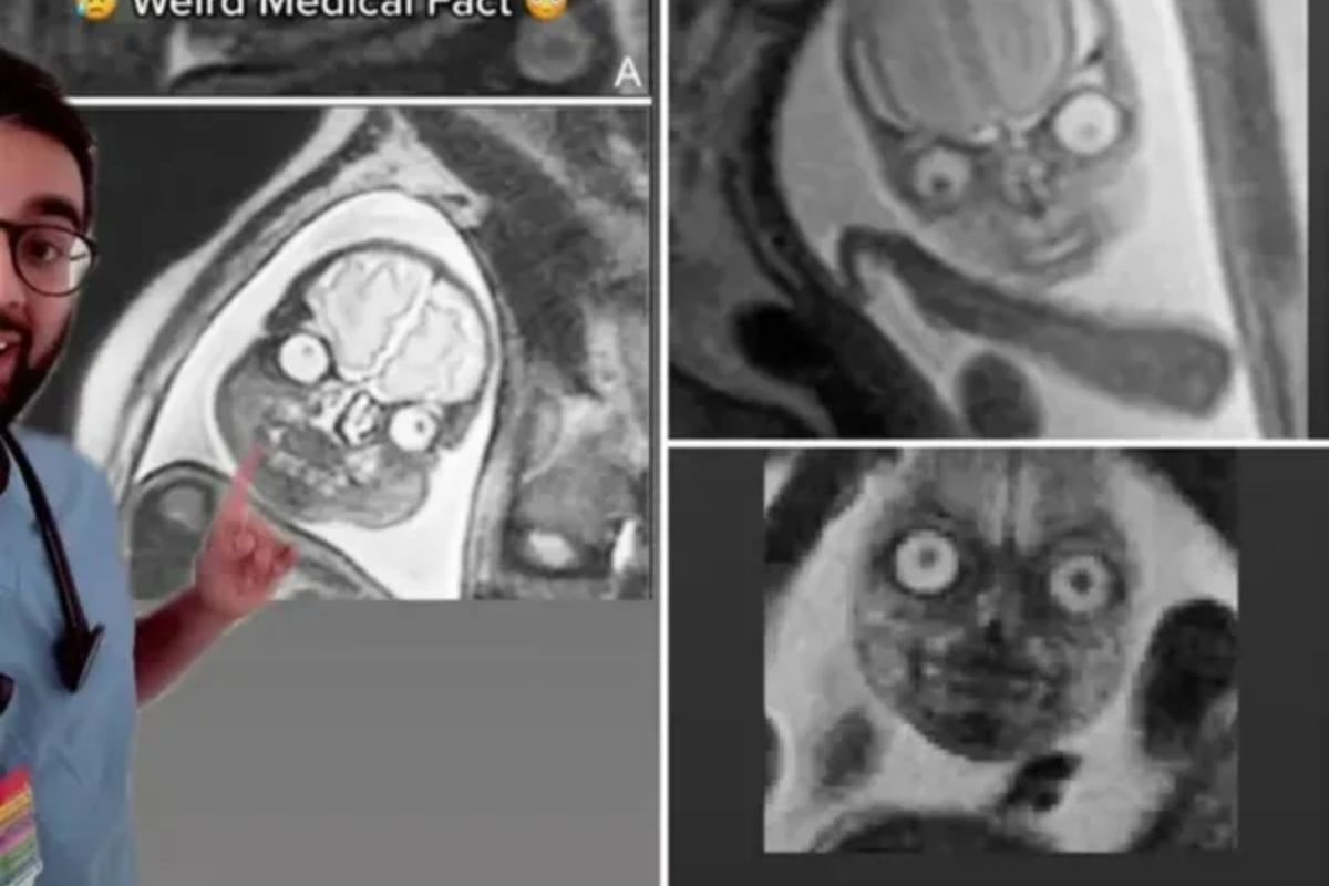 एमआरआय स्कॅनमध्ये गर्भाशयातील बाळे कशी दिसतात?मजेशीर VIDEO सोशल मीडियावर व्हायरल