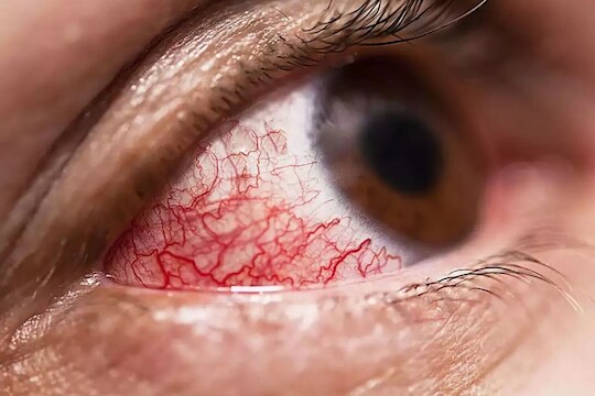 कोरोना लसीचे दोन्ही डोस घेतलेल्यांना Mucormycosisचा धोका शून्य?