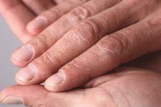 कोरोना रुग्णांच्या नखांमध्ये होतोय बदल; तुमच्यामध्येही असं लक्षण तर नाही ना?