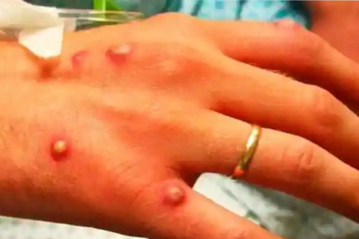 कोरोनापाठोपाठ आणखी एक संकट! संसर्गजन्य Monkeypox चा रुग्ण आढळल्यानं खळबळ